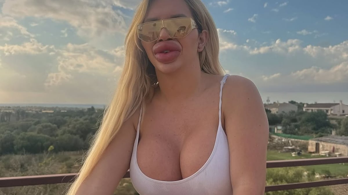 Sie gab schon über 43.000 Euro aus: Influencerin wünscht sich die dicksten Lippen der Welt