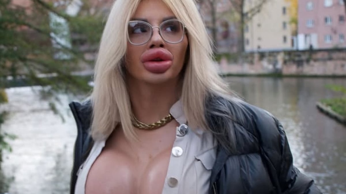 Sie gab schon über 43.000 Euro aus: Influencerin wünscht sich die dicksten Lippen der Welt